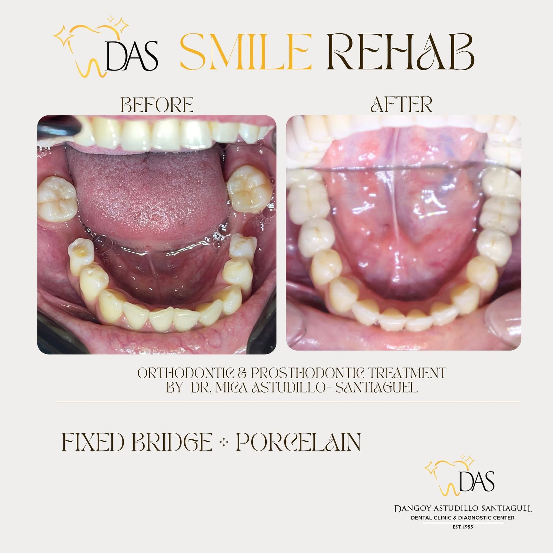 DAS Dental post: Smile Rehab, fixed bridge and porcelain, before and after