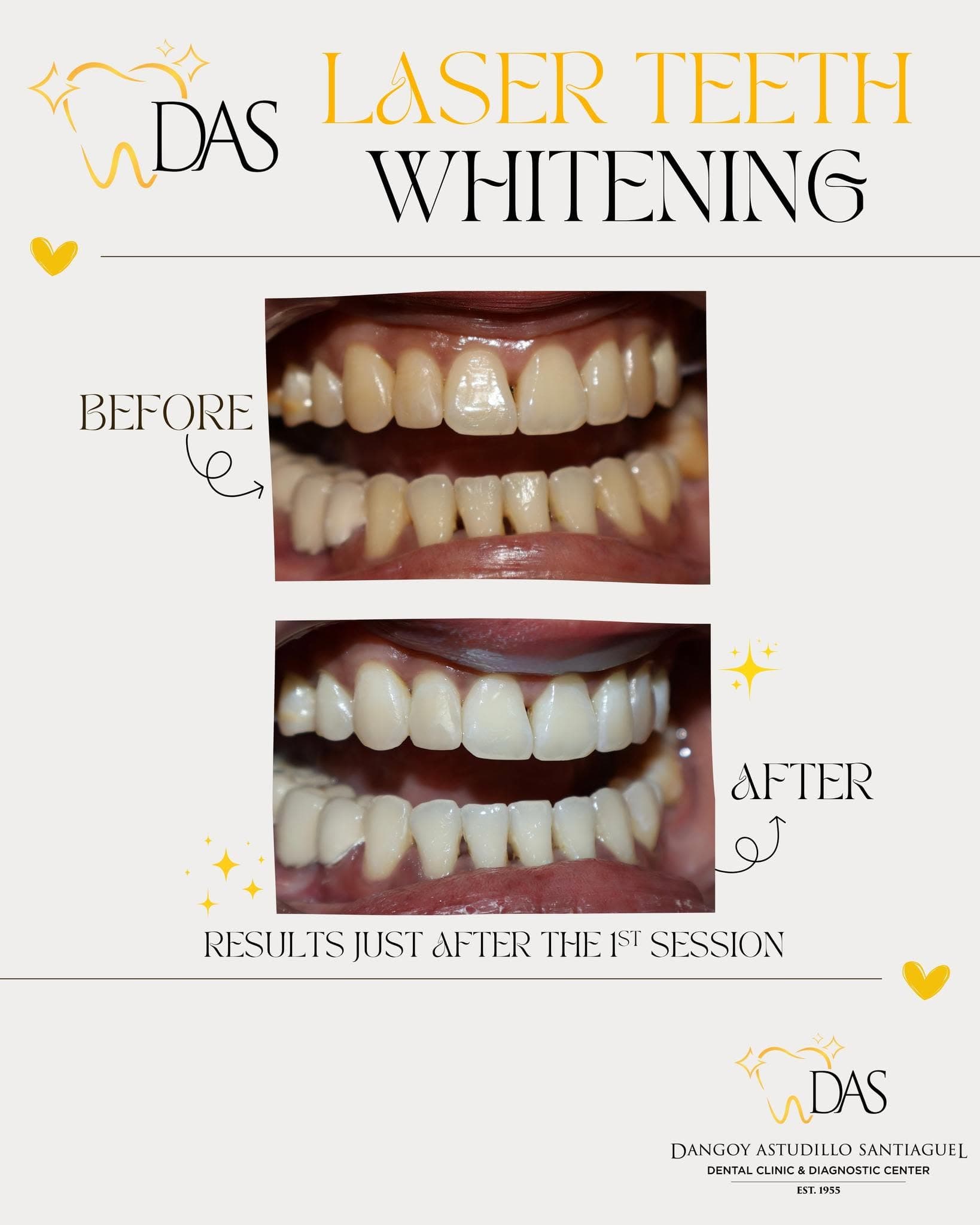 DAS Dental post: Laser teeth whitening, before and after