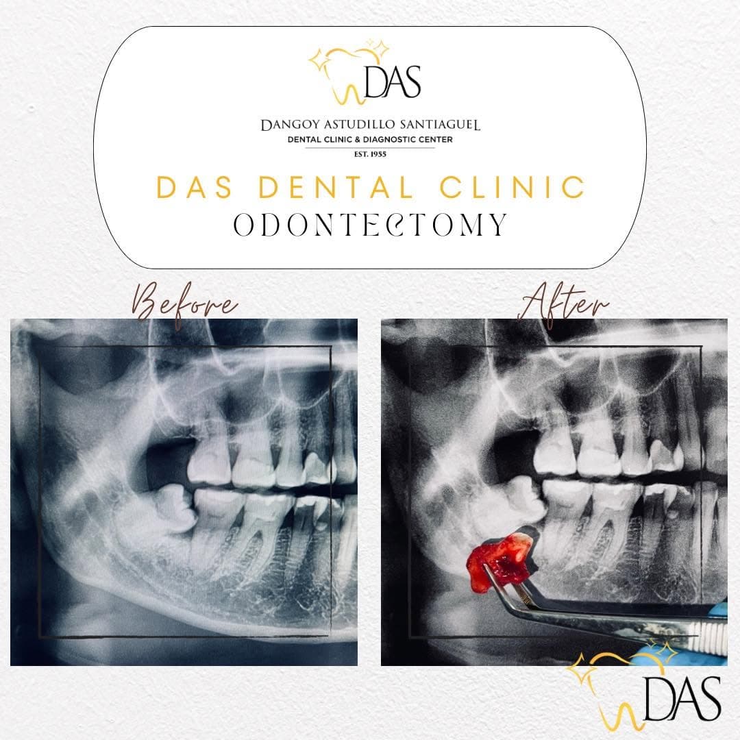 DAS Dental post: Odontectomy X-rays, before and after