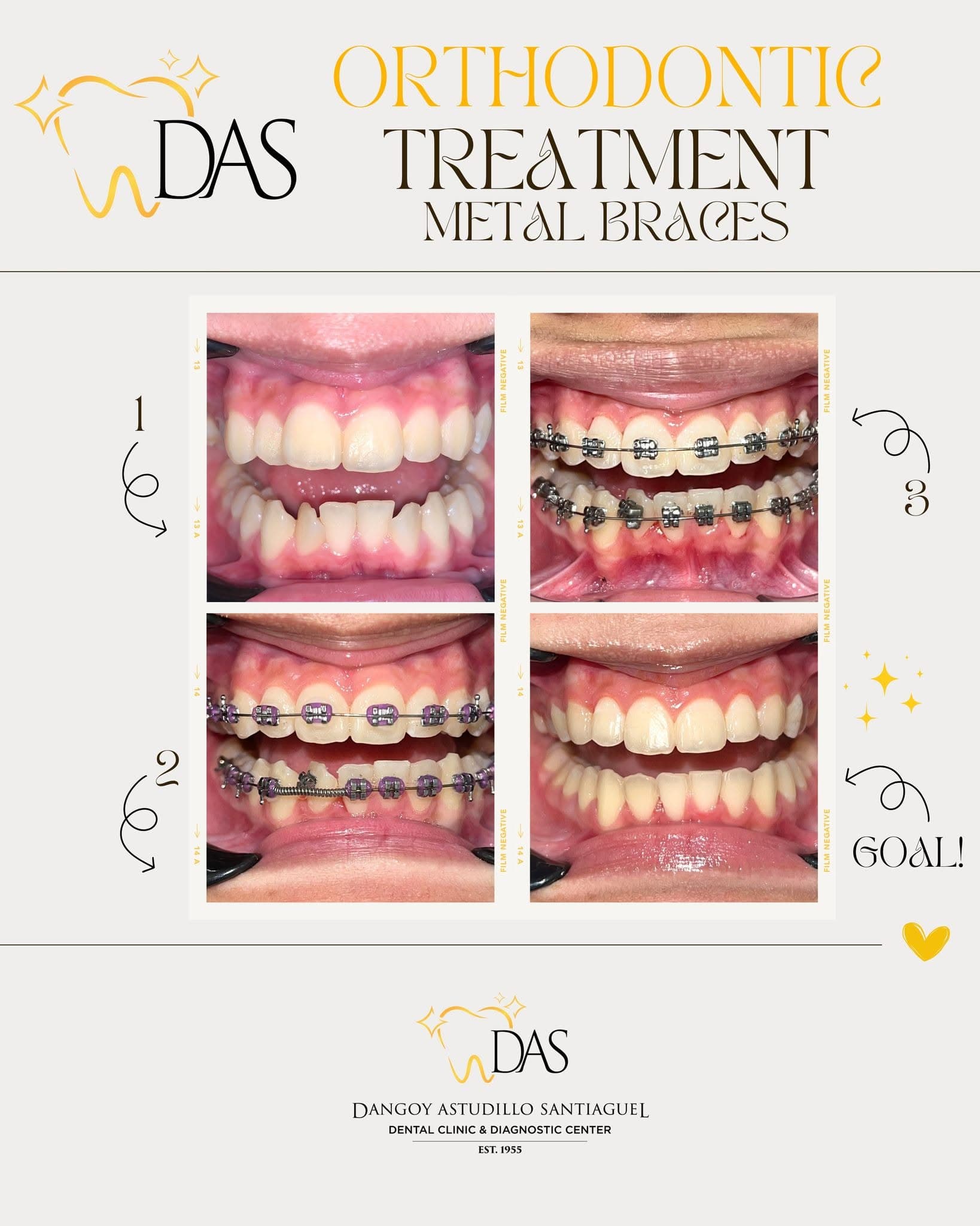 DAS Dental post: Orthodontic treatment with metal braces, four stages