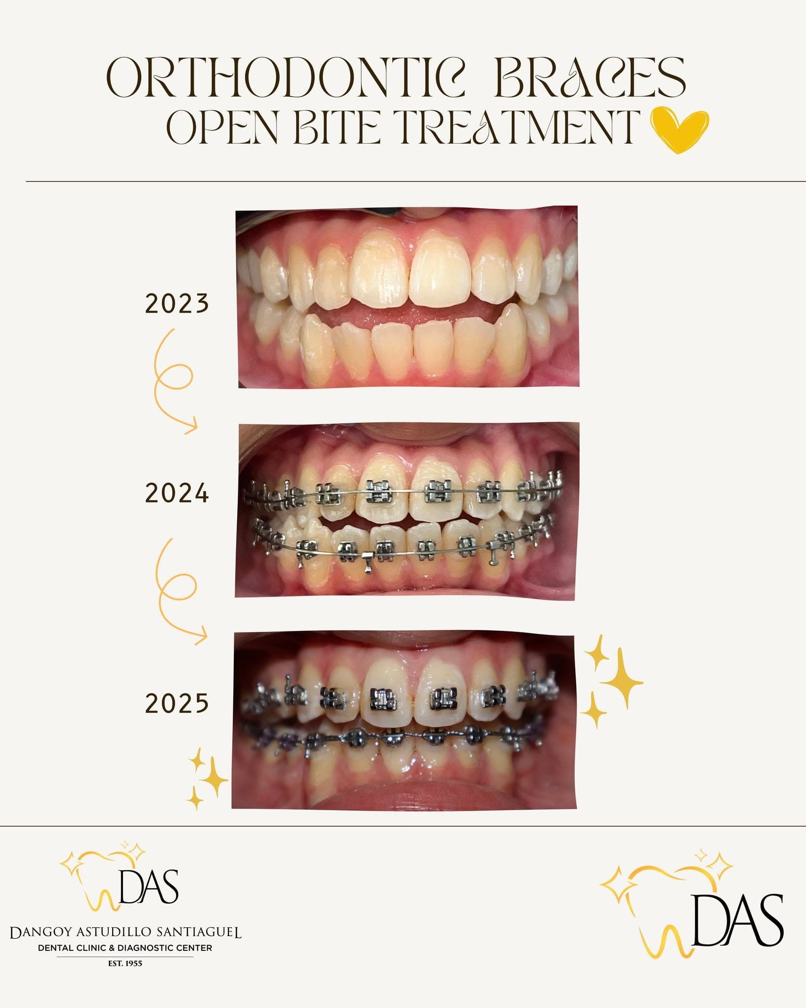 DAS Dental post: Orthodontic braces for an open bite, 2023 to 2025