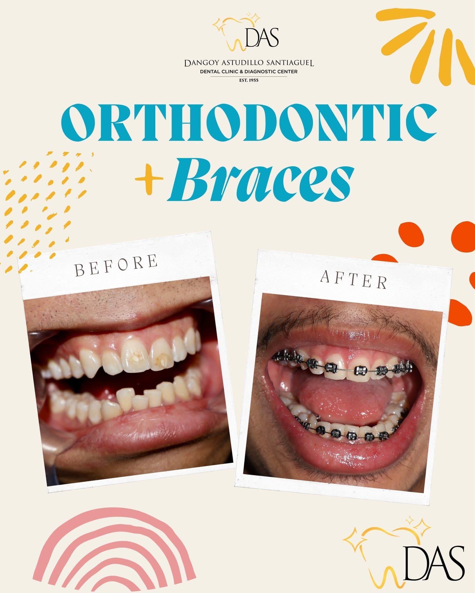 DAS Dental post: Orthodontic braces, before and after