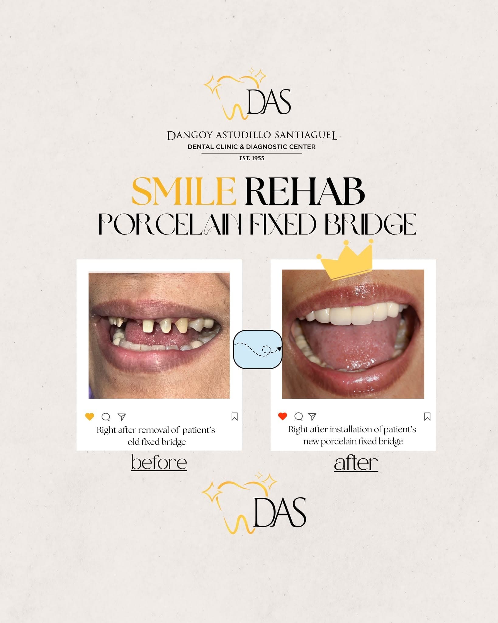 DAS Dental post: Smile Rehab, porcelain fixed bridge, before and after