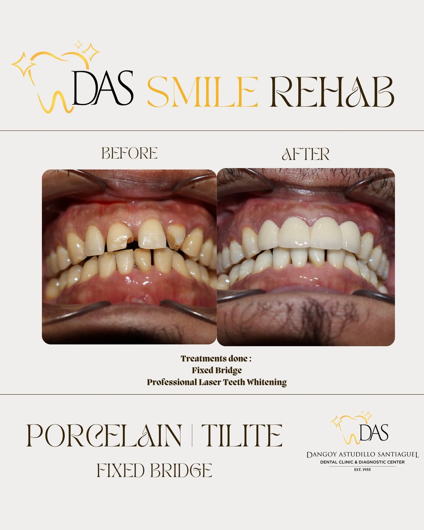 DAS Dental post: Smile Rehab, porcelain and Tilite fixed bridge, before and after