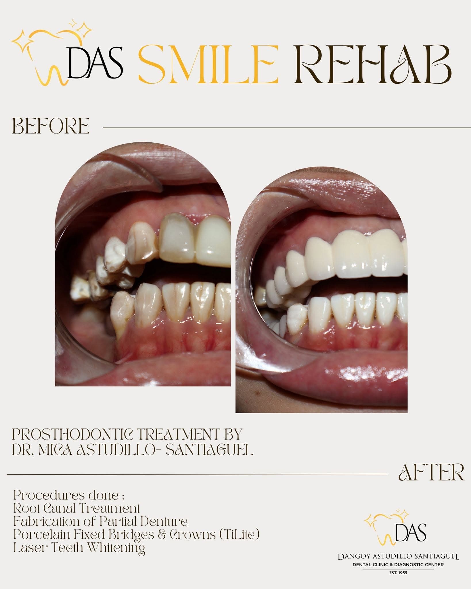 DAS Dental post: Smile Rehab, prosthodontic treatment, before and after