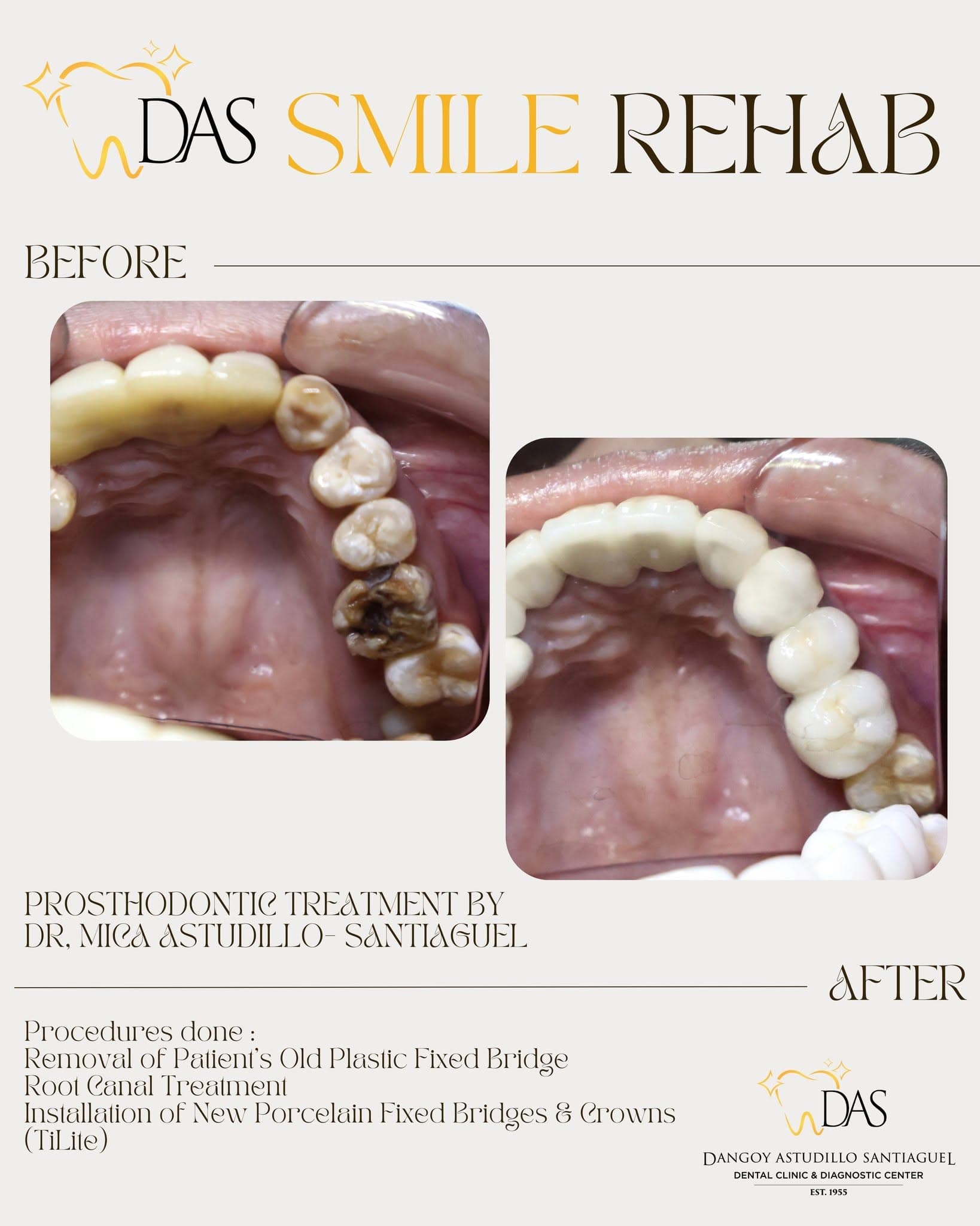 DAS Dental post: Smile Rehab, prosthodontic treatment, before and after