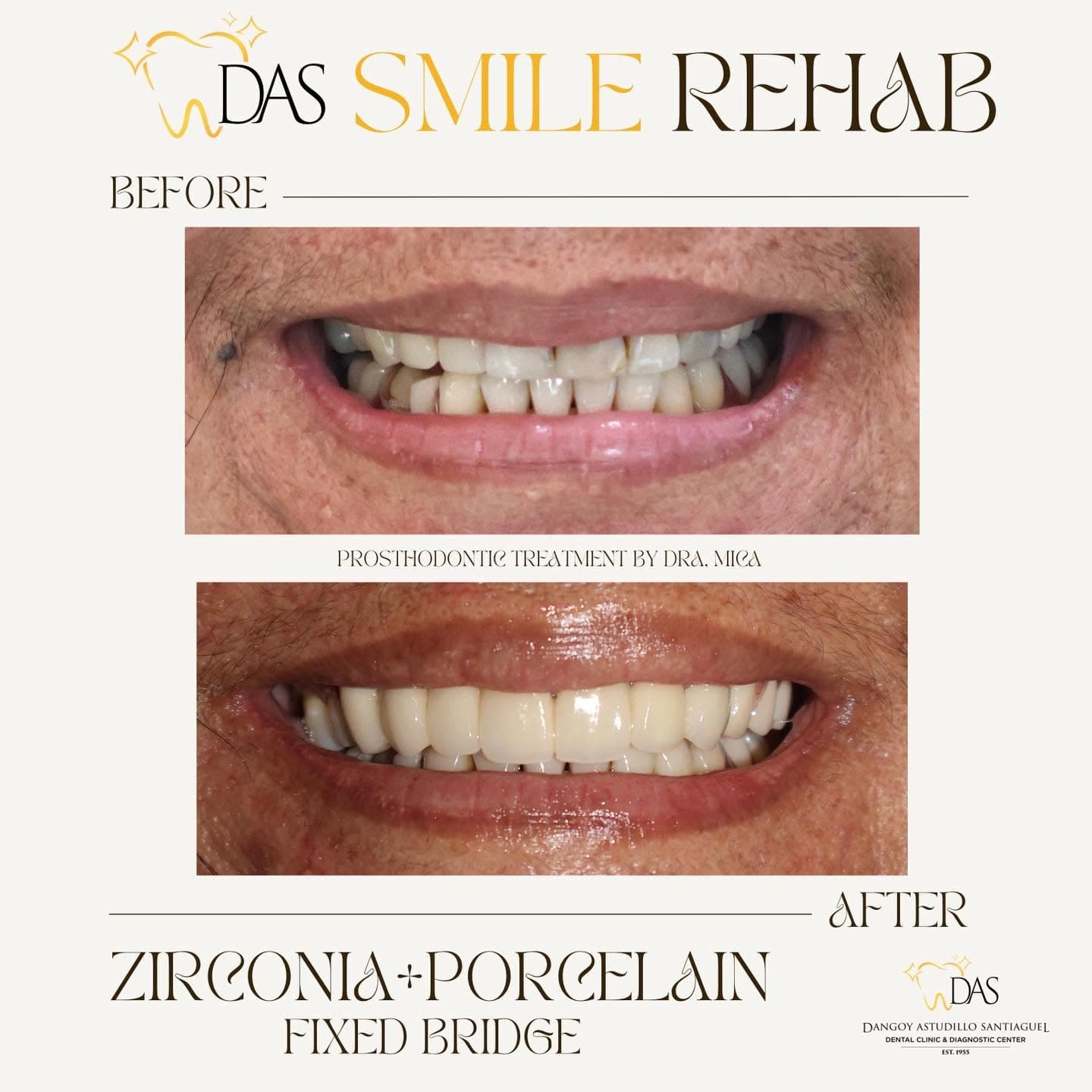 DAS Dental post: Smile Rehab, zirconia and porcelain fixed bridge, before and after