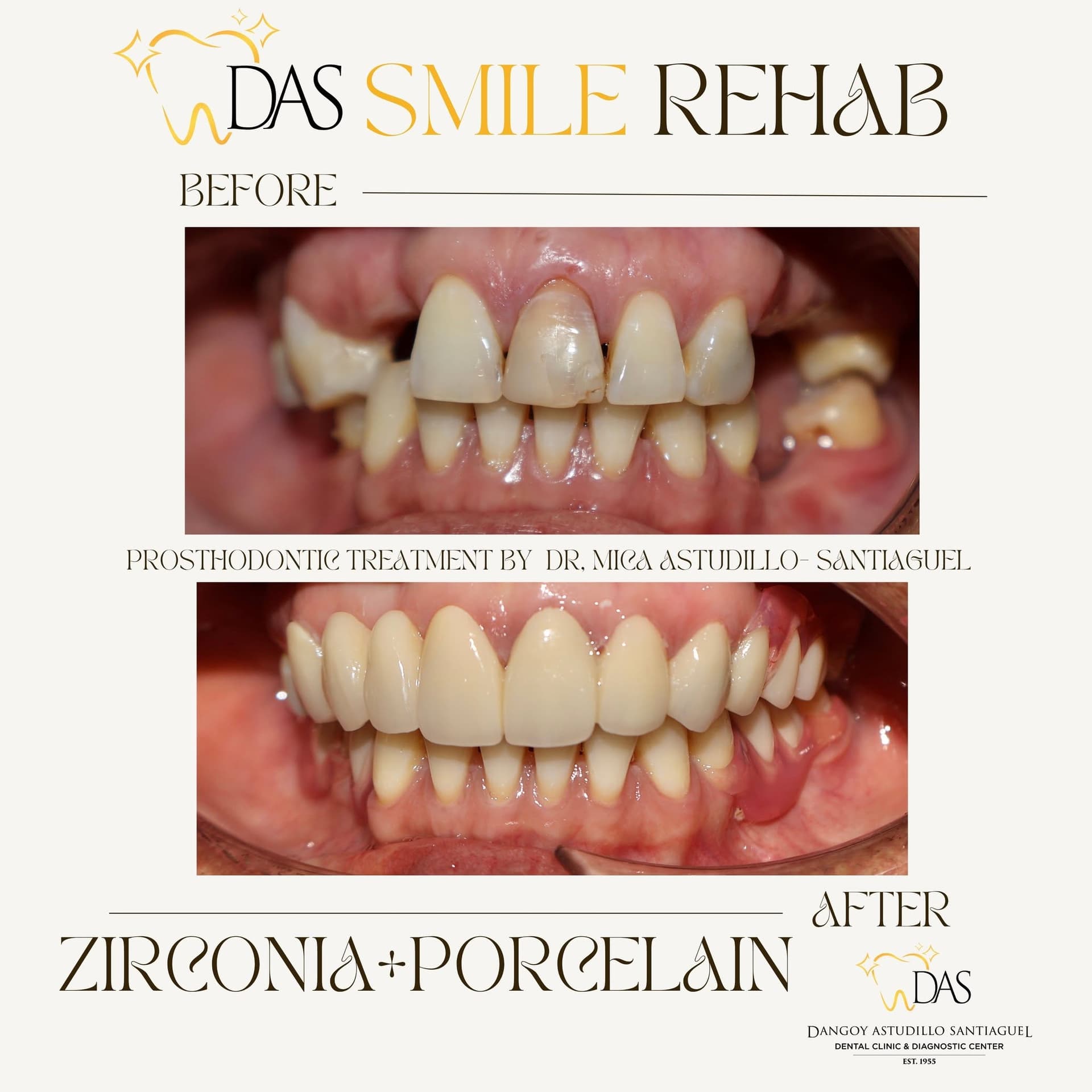 DAS Dental post: Smile Rehab, zirconia and porcelain, before and after