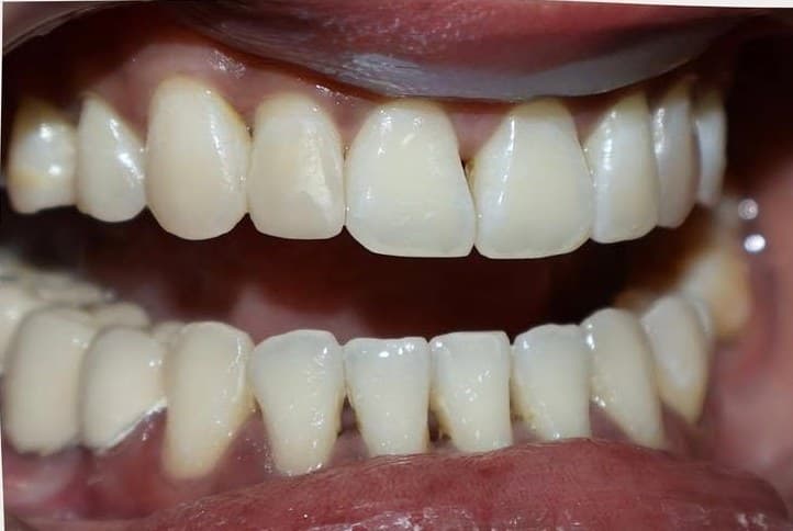 Close-up of front teeth after professional whitening