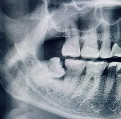 Dental X-ray showing an impacted tooth