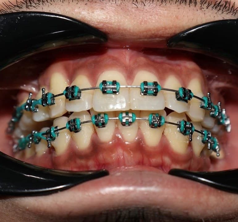 Teeth with orthodontic braces