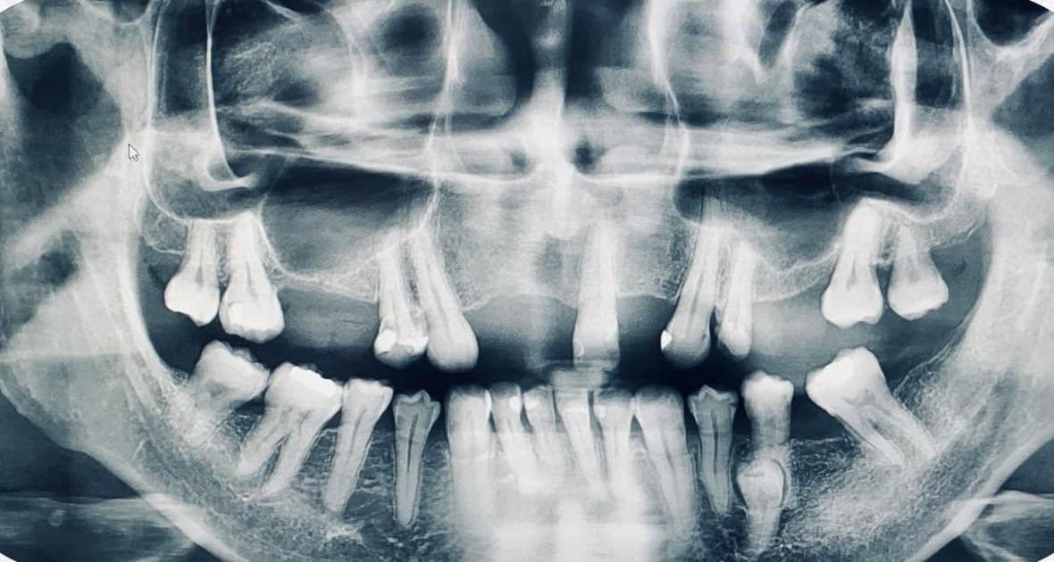 A digital panoramic dental X-ray