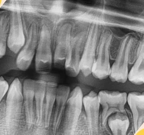 Dental X-ray of a child's developing teeth