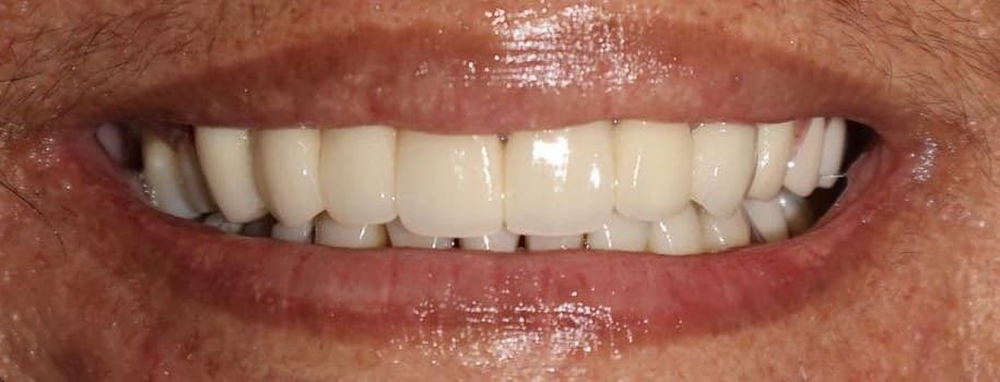 A smile restored with a fixed bridge